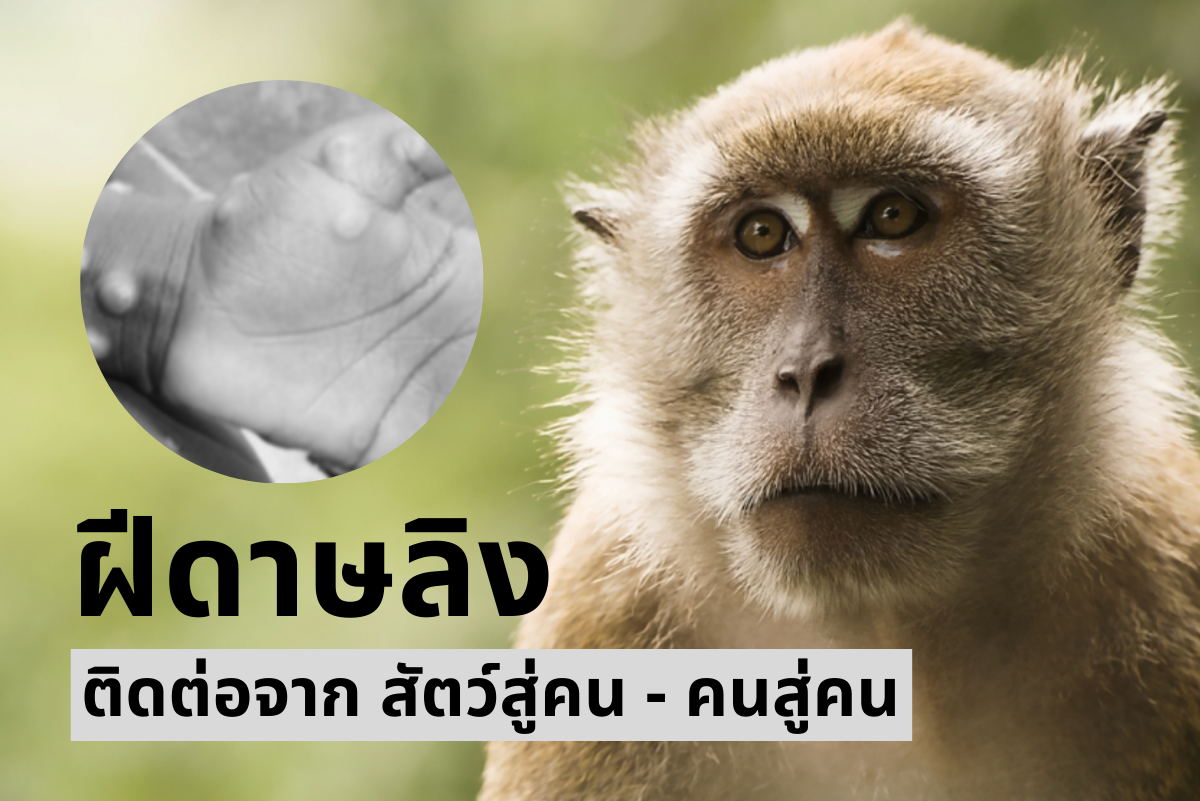 ไวรัส ‘ฝีดาษลิง’ คืออะไร อันตรายแค่ไหน?